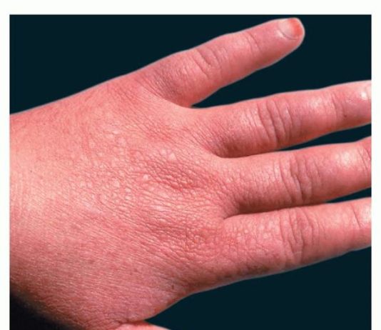 स्कॉट्लैंड की ख़तरनाक बीमारी ‘डेरियर’ की चपेट में उत्तर प्रदेश!