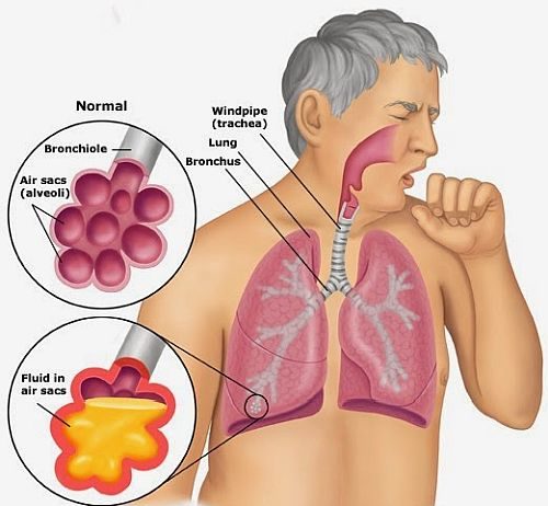 अब प्राइवेट मेडिकल स्टोर भी देंगे टीबी की मुफ्त दवाई!