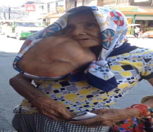 फिलीपींस की इस महिला का सर से बड़ा है ट्यूमर, ऑपरेशन के डर से ऐसे जी रही है जिंदगी