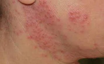 दाद – खाज – खुजली हो तो अपनाये ये तरीके