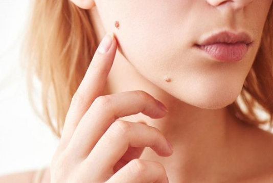 मस्सों को जड़ से खत्म करने का ये नुस्खा है बेहद असरदार, तुरंत दिखेगा असर