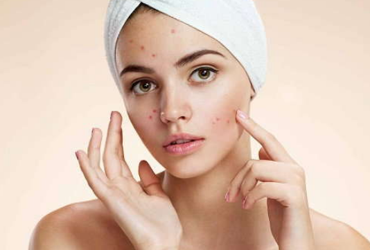 रिपोर्ट में खुलासा: आपके चेहरे के मुहांसे सिर्फ सुंदरता ही नहीं दिमाग पर भी होता है असर