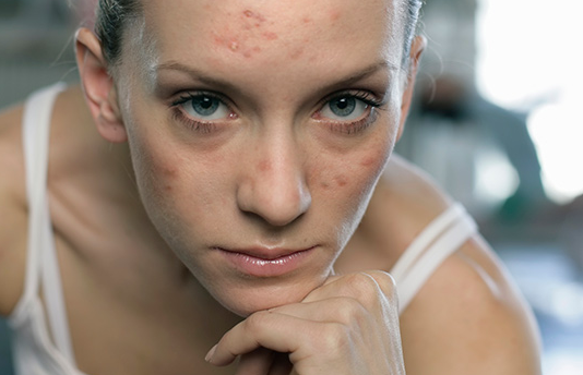 आपके चेहरे पर मुहांसे का डाइट से है पूरा कनेक्शन, शोध में खुलासा