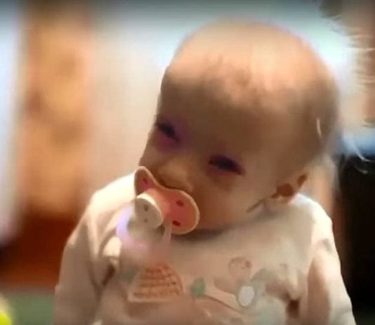 हैरतअंगेज करने वाली बीमारी, 8 साल की बच्ची बूढ़ी होकर मर गई