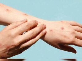 भारत में मंकीपॉक्स के मामले ने बढ़ाई चिंता, जानिए इसके क्या हैं लक्षण ?