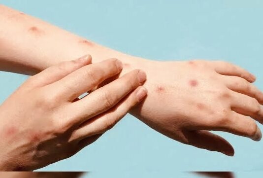 भारत में मंकीपॉक्स के मामले ने बढ़ाई चिंता, जानिए इसके क्या हैं लक्षण ?